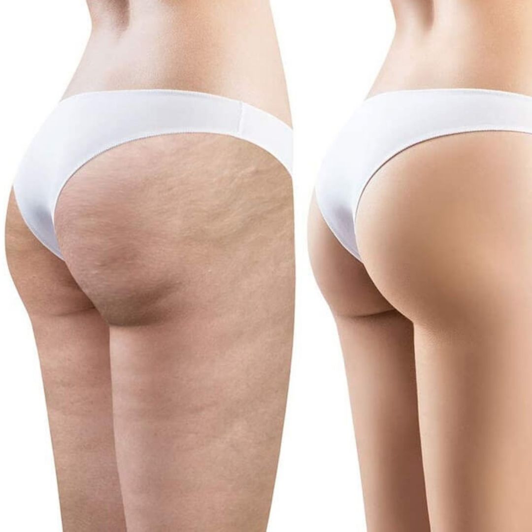cellulite2.jpg